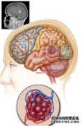 间断头痛10年，竟是颅内“鸡蛋大小”海绵状血管瘤惹的祸