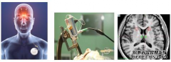 河南三博脑科医院脑起搏器免费植入救助项目开启了